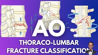 AO Classification Thoracolumbar Fractures [upl. by Xella276]