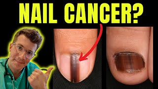 Cancer of the nail Doctor ODonovan explains Acral Lentiginous Melanoma and Subungual Melanoma [upl. by Jessen]