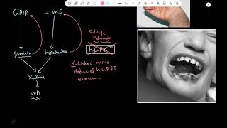 LeschNyhan syndrome  Pathology [upl. by Tommie]