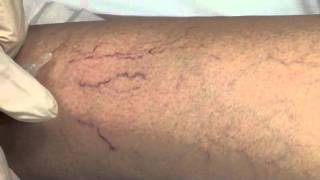 Spider Vein Sclerotherapy [upl. by Daiz]