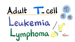 Adult T cell Leukemia  Lymphoma  Human Tcell Leukemia Virus HTLV1  Oncology [upl. by Sobmalarah]