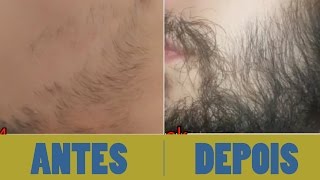 Antes e depois  minoxidil kirkland  barba  7 meses [upl. by Nosde]