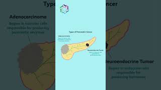 Types of Pancreatic Cancer Explained  Knowing the Different Forms  Dr Vivek Sukumar [upl. by Howzell]