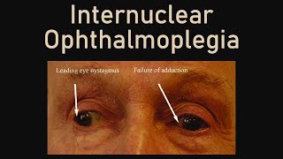 Internuclear Ophthalmoplegia [upl. by Toolis]