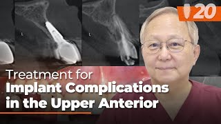 Treatment for Implant Complications in the Upper Anteriorㅣ Soft Tissue Grafting [upl. by Lemay]