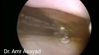 Endocervical polyp and Nabothians Cyst [upl. by Nalrah]