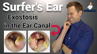 CRAZY Growth in the Ear Canal  Surfers Ear due to Exostosis [upl. by Toback]