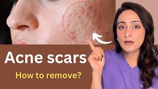 How to reduce Acne Scar  Chemical peels Dermaroller Lasers  Cost  Dermatologist Dr Aanchal [upl. by Klement]