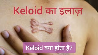 Keloid का इलाज  Hypertrophic Scar  Keloid treatment  keloid injection treatment  keloid scar [upl. by Navaj924]