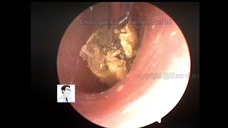 Ear Wax Removal Cerumen Cleaning Collection20220618 [upl. by Kowalski]