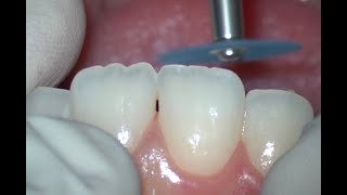 Enameloplasty Upper Central Incisors [upl. by Odnala]