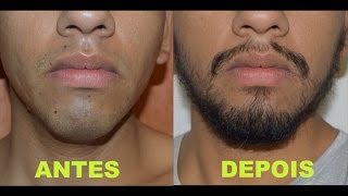 Antes e depois  minoxidil kirkland  barba  7 meses [upl. by Cilegna]