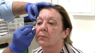 Injecting Botox into the Glabella region  Training Video For Medical Professionals Only [upl. by Annawat429]