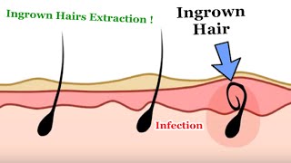 Removing Ingrown Hairs  2D Animation [upl. by Maffei]