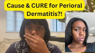 What causes PERIORAL Dermatitis And How to heal it Naturally [upl. by Catto]