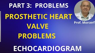 Problems With Prosthetic Valves Part 3 echocardiography [upl. by Anid]