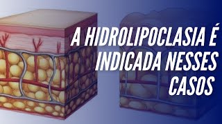 A hidrolipoclasia é indicada nesses casos [upl. by Aroved]