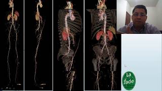 Angiotomografia de aorta e MMII IMAGENS 3D [upl. by Hamas]