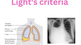 Pleura  Pleural effusion  Lights criteria  Transudate  Exudate Empyema [upl. by Galven]