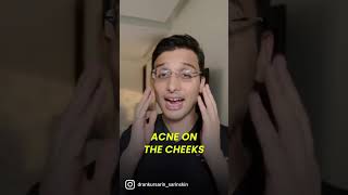 Getting acne on specific areas of the face  Dr Ankur Sarin [upl. by Adnot]