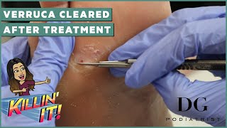 Verruca removal treatment with clearal results  The Foot Scraper DG Podiatrist [upl. by Nilved]