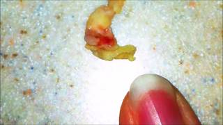 Worlds Largest Tonsil Stones  Cured [upl. by Lazes287]