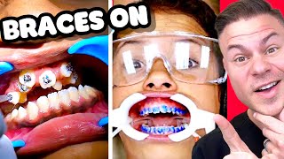 How Braces Are Put On  Watch Before You Get Braces [upl. by Tiffy297]