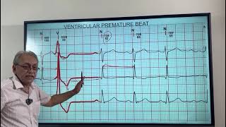 VENTRICULAR ECTOPICS  VENTRICULAR PREMATURE BEATS HOW TO DIAGNOSE ON ECG [upl. by Ynomrah]