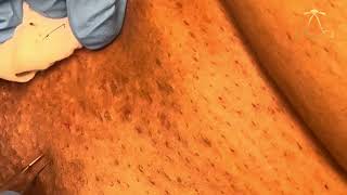 Ingrown Hair Extraction  Body  Episode 45 [upl. by Oeflein401]