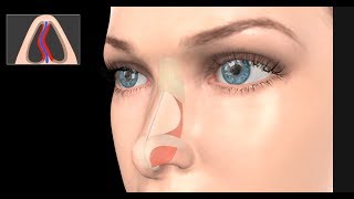 Deviated Septum Surgery Septoplasty [upl. by Arty]