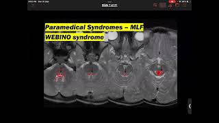 SNN MS infocus Pontine MS syndromes [upl. by Edia264]