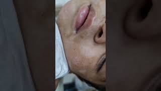 White spots on face in children  pitryiasis alba  home remedies and treatment  calcium deficiency [upl. by Mairb]