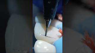 Mastering direct restoration of anterior teeth DentalEducation AnteriorRestoration [upl. by Ailima]