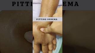 Peripheral Edema Causes of edema amp How to check edema in just 1min [upl. by Annodas]