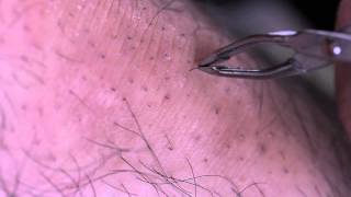 ingrown hair leg hair [upl. by Oram302]