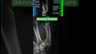 Thumb Fracture  Bennett’s fracture shorts radiology xray trauma [upl. by Frodi]