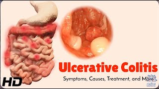 Ulcerative Colitis Explained Symptoms Causes and Treatment Options [upl. by Sukramed]