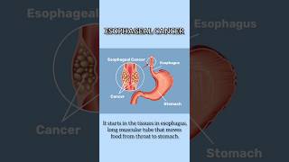 Esophagus cancer I Treatment for Esophagus cancer in Delhi [upl. by Akcebar45]