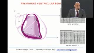 Arrhythmogenic right ventricular cardiomyopathy AZorzi [upl. by Santana]