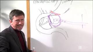 Distal Pancreatectomy Procedure  Roswell Park Patient Education [upl. by Luapleahcim]