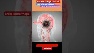 Brain Hemorrhage Treatment l Mannitol l Craniotomy stroke shorts [upl. by Irotal]