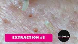 Whitehead and BlackHead RemovalExtraction 3 Reedit [upl. by Amsirp]