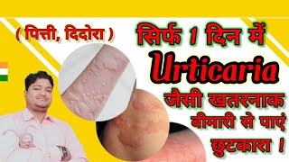 urticaria  पित्ती उछलना  best homeopathy medicine for urticaria  How to Treat Urticaria Fast [upl. by Solracesoj]