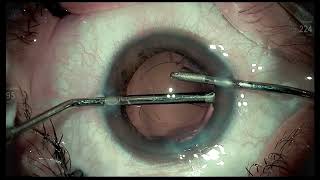 Posterior polar cataract  Alcon Vivity EDOF Lukan Mishev [upl. by Monarski]