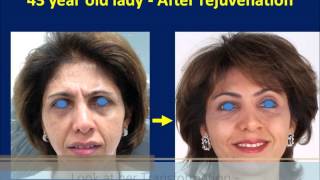 Botox amp Dermal Filler Injection Made Her Young Again  Liquid Facelift Technique [upl. by East]