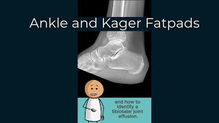 The Kager Fat Pad and Tibiotalar joint effusion [upl. by Einnal221]