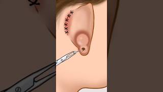 AMSR infected are piercing removal animation P2animationamsrviralshorts [upl. by Neersan618]