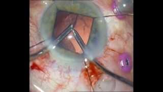 Traumatic cataract after intravitreal antiVEGF injection [upl. by Eical501]