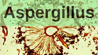 Aspergillus and Aspergillosis  Pathology mini tutorial [upl. by Darb]