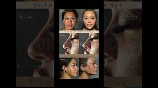 DrFarzan Malekzadeh  Picasso Technique no Surgery beauty picassotechnique drfarzanmalekzsdeh [upl. by Rasaec]